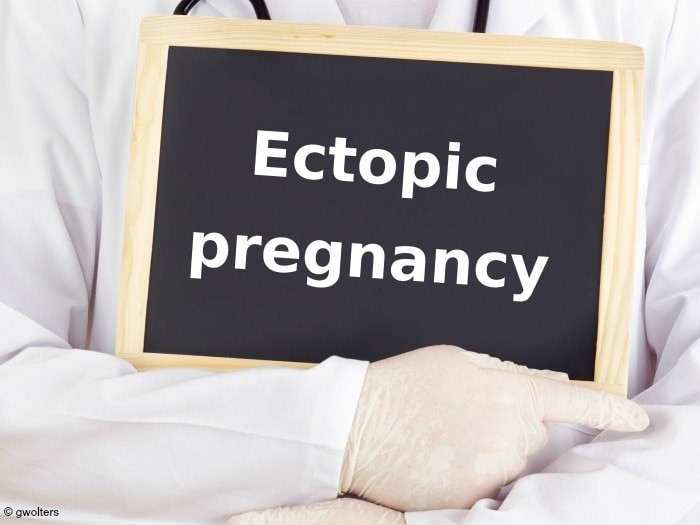 My Story of Ectopic Pregnancy