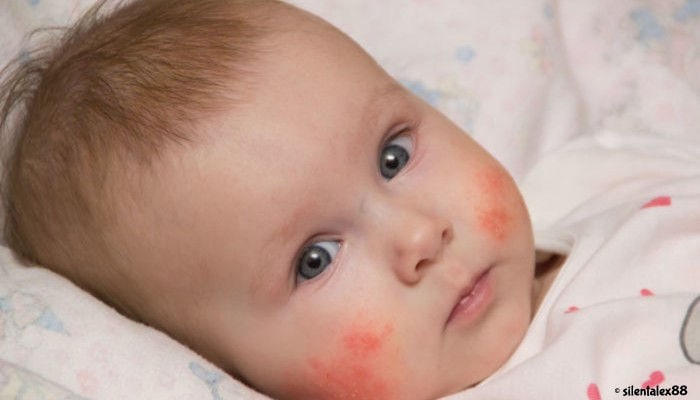 A New Mom’s Guide to Baby Rashes